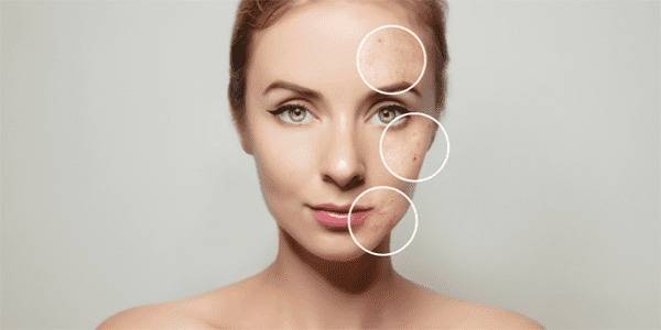 Boutons, acné : les différents types