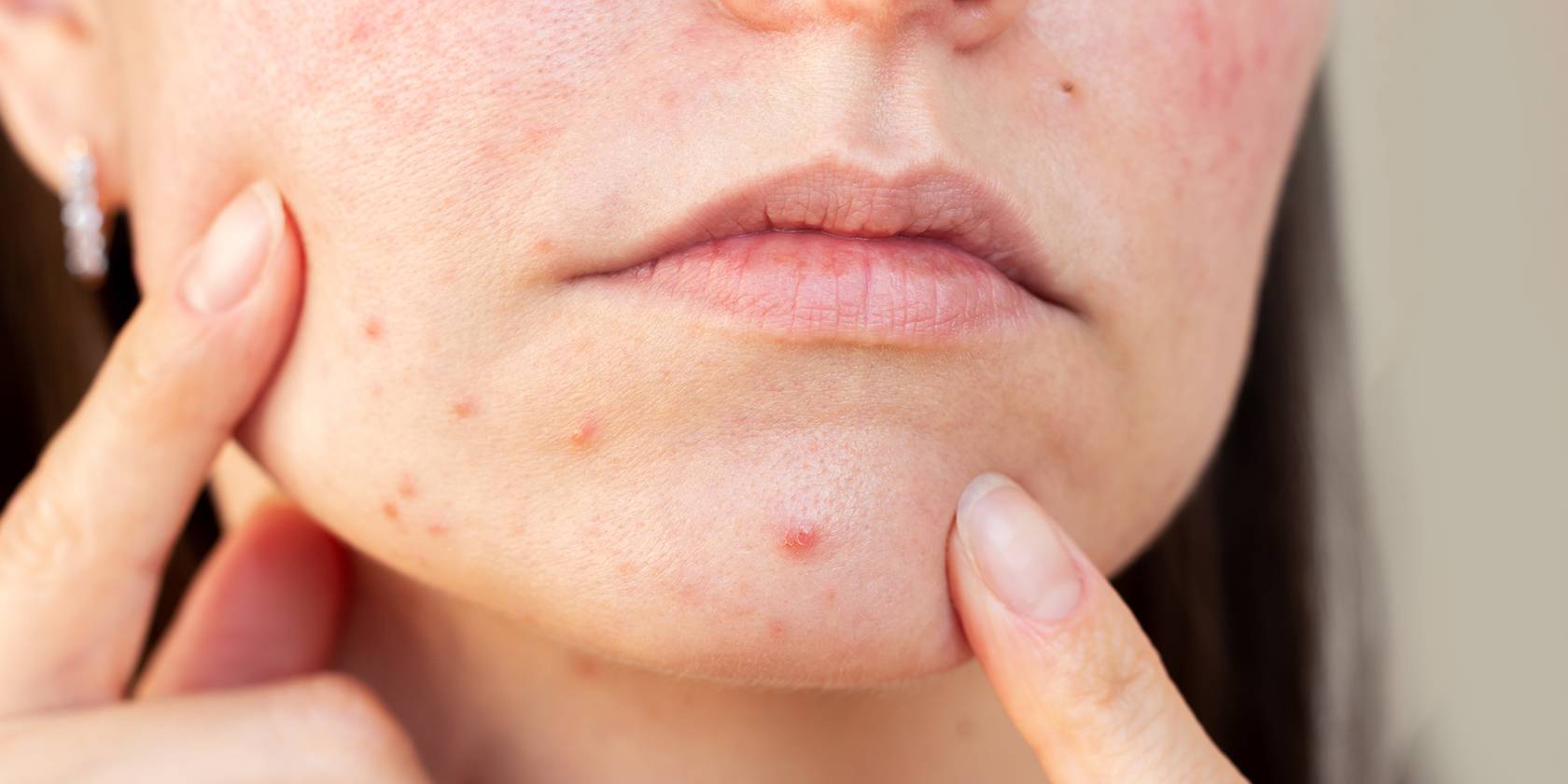 Excès de sébum : causes et solutions