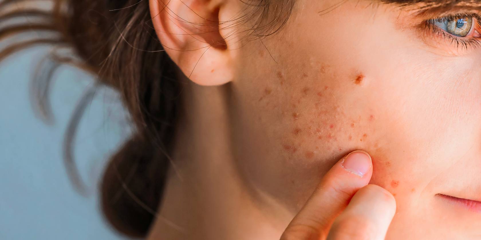 Zinc et acné : quel effet sur les boutons ?