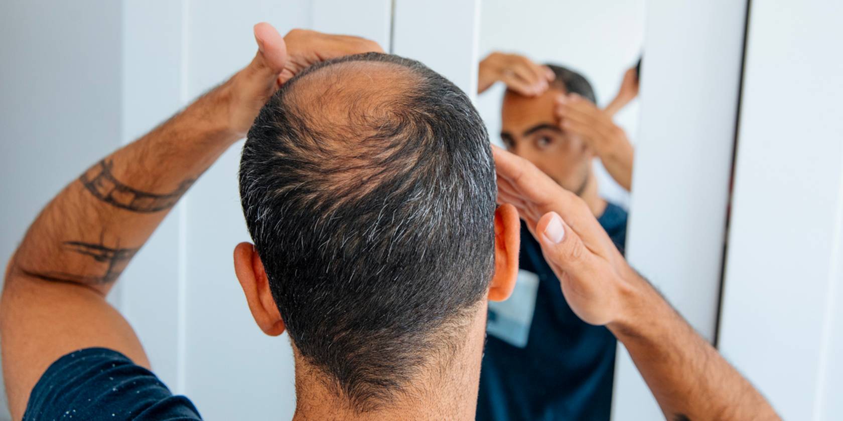 Calvitie : zoom sur la perte de cheveux chez l’homme