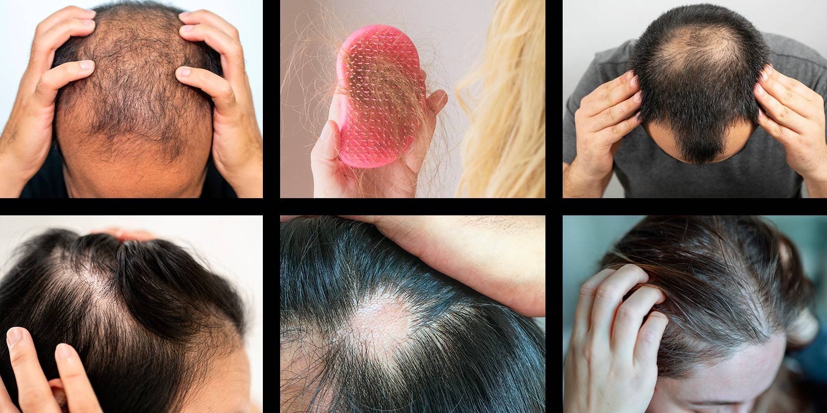 Les types de chutes de cheveux