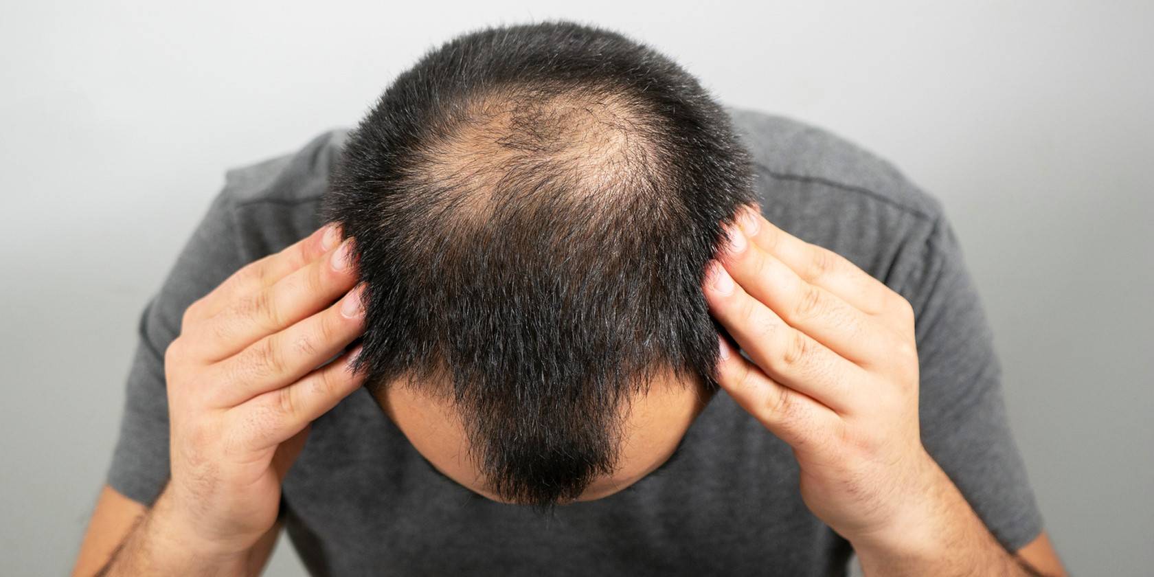 Alopécie androgénétique