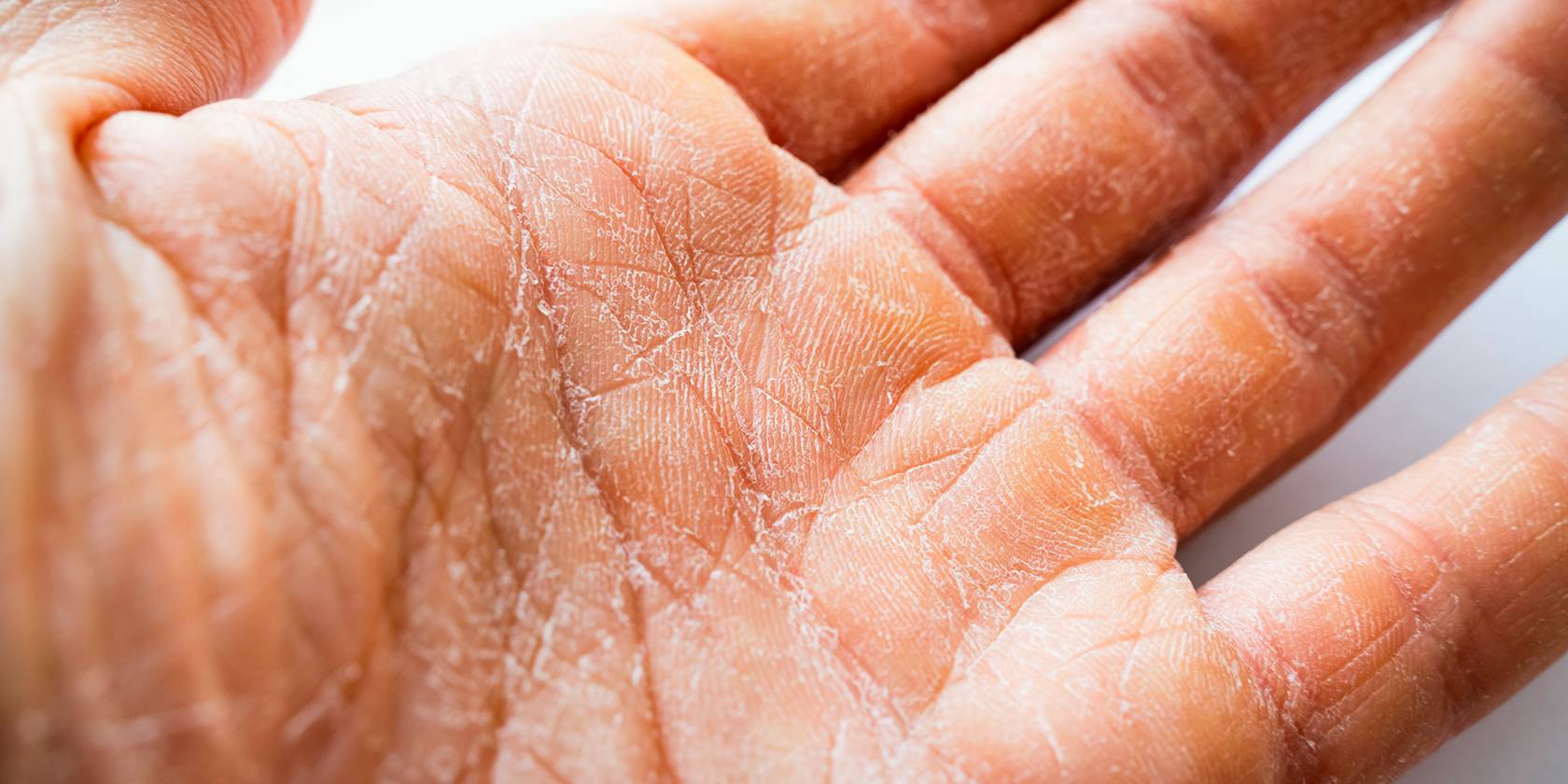 Peau déshydratée : origine et routine à adopter